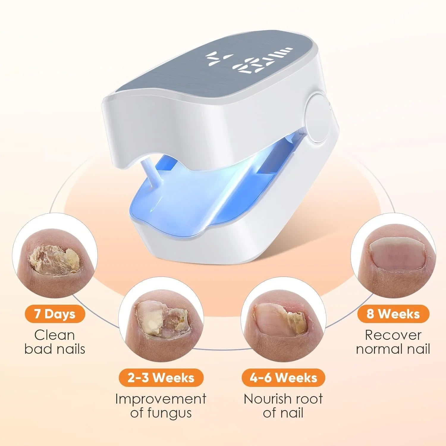 Appareil de traitement au laser pour ongles anti-mycose