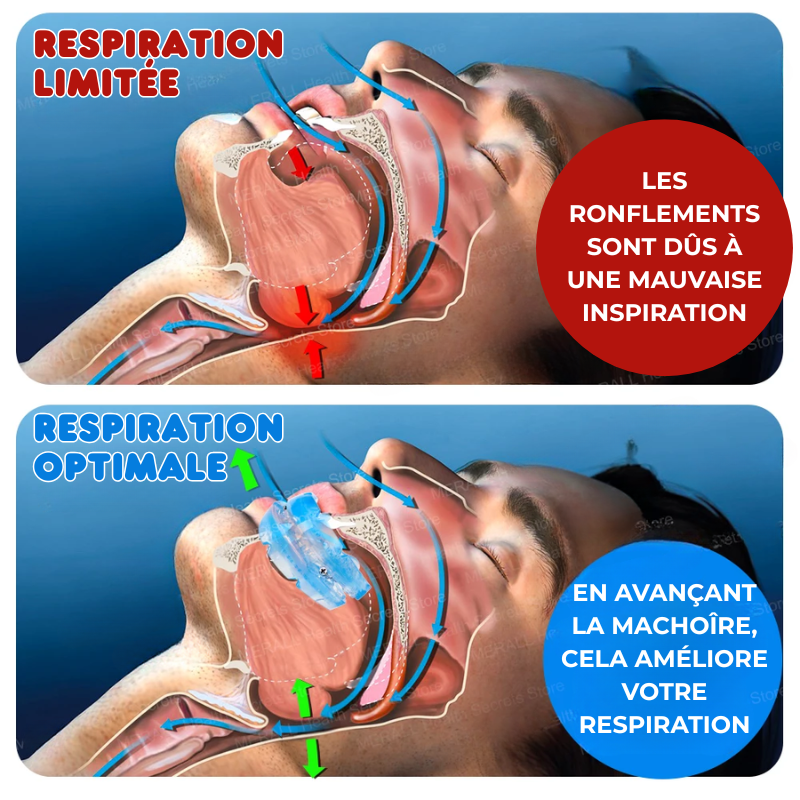 SILENCE SLEEP - Anti-Snoring & Anti-Apnea Mouthpiece